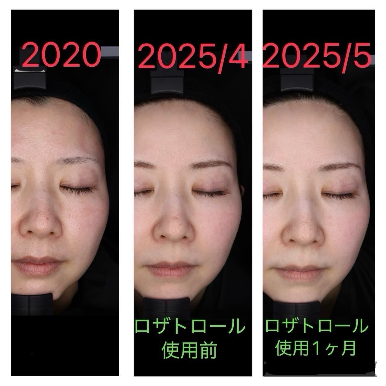 赤ら顔にロザトロール - 神戸の美容皮膚科なら【さわこ形成外科